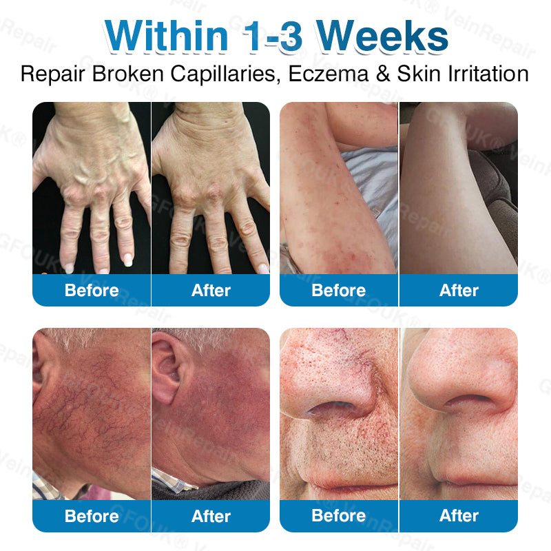 GFOUK® VeinRepair Microneedle Patch Roll⚡Instant Relief, Long-Term Results