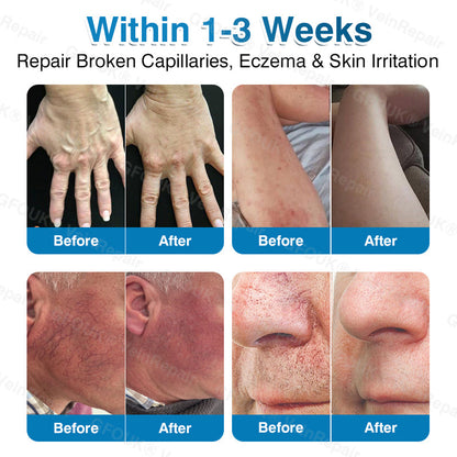 GFOUK® VeinRepair Microneedle Patch Roll⚡Instant Relief, Long-Term Results