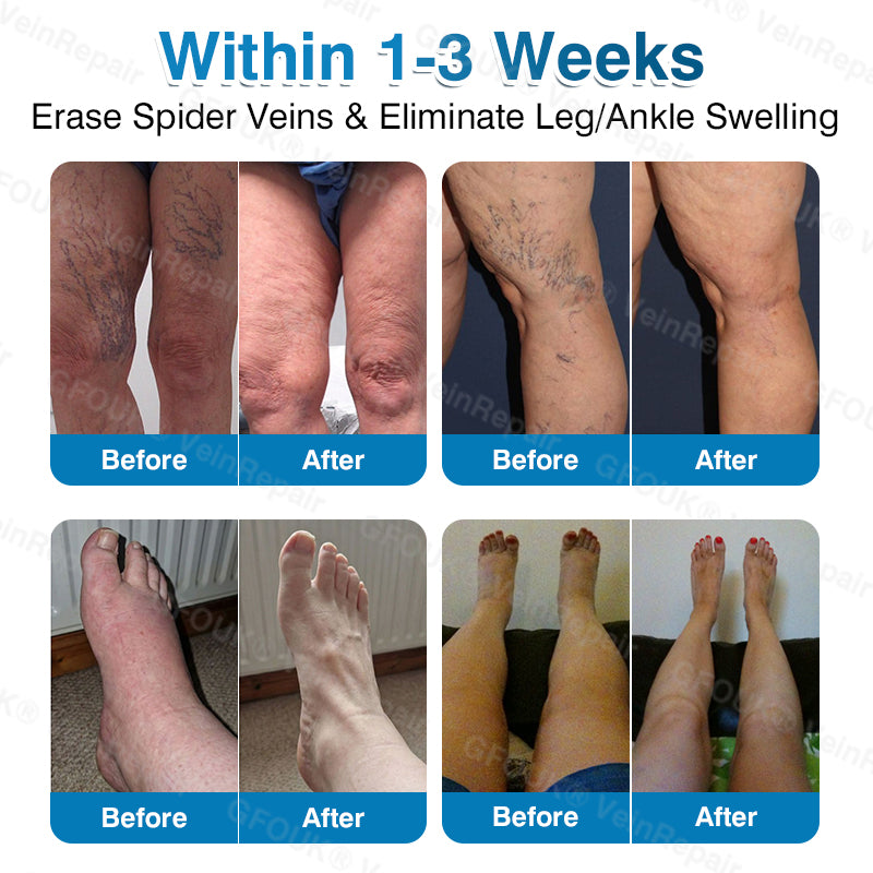 GFOUK® VeinRepair Microneedle Patch Roll⚡Instant Relief, Long-Term Results
