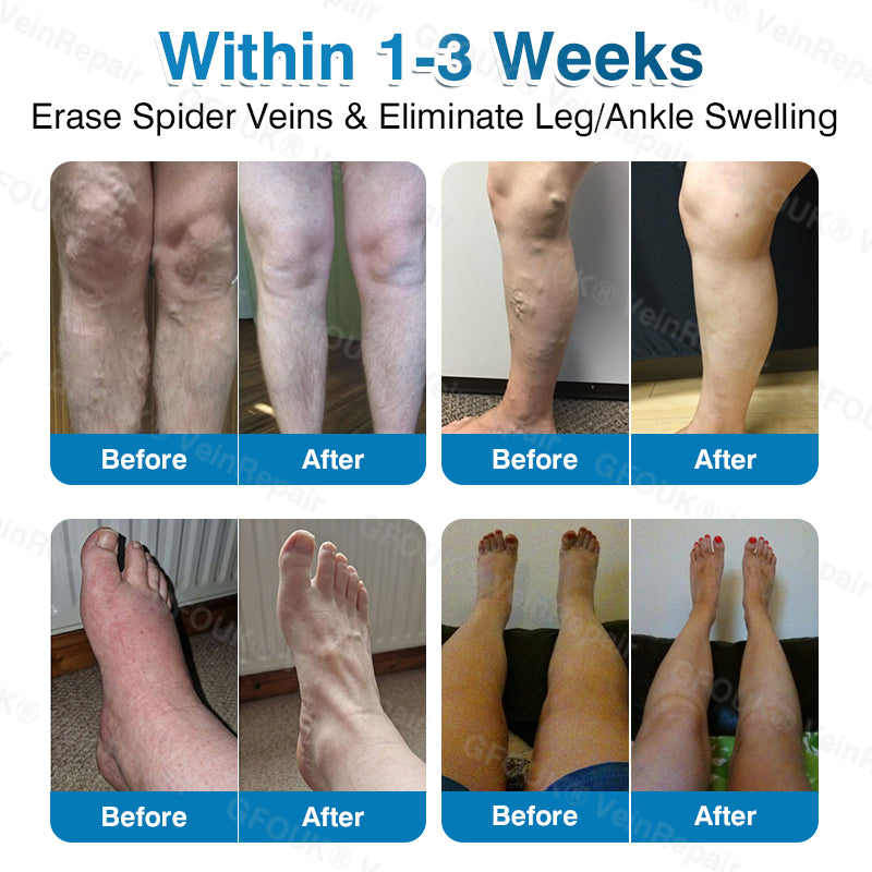 GFOUK® VeinRepair Microneedle Patch Roll⚡Instant Relief, Long-Term Results