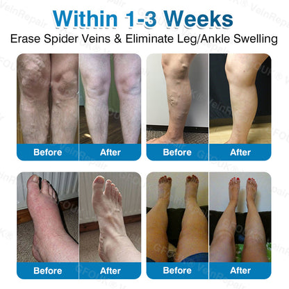 GFOUK® VeinRepair Microneedle Patch Roll⚡Instant Relief, Long-Term Results